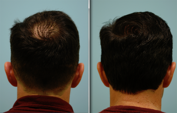 Corrective Hair Transplants Before and After Photo