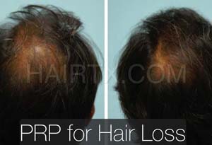 PRP and ACell for Hair Loss Results Dallas