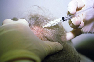 Intralesional steroid injection alopecia areata