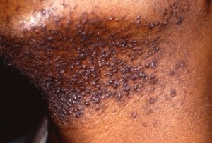 black-hair-pseudofolliculitis-barbae