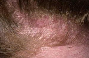 seborrheic dermatitis of the scalp #9