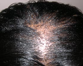 Topical steroid for ringworm