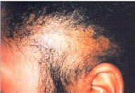 traction-alopecia