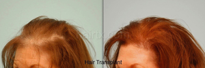 Hair Restoration Before and After Plano Tx