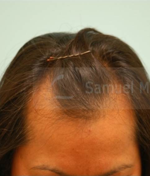 Asian Hair Transplant