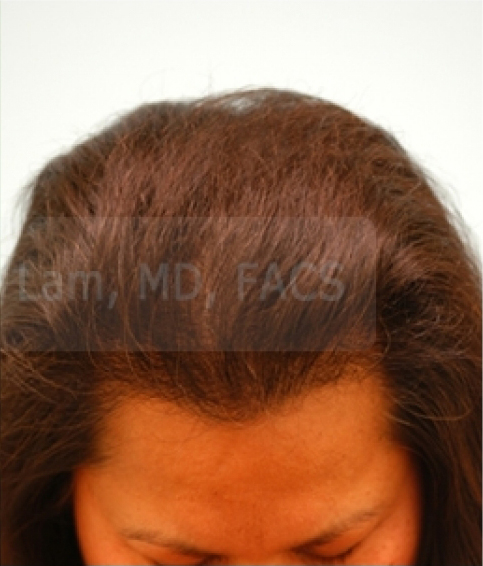 Asian Hair Transplant