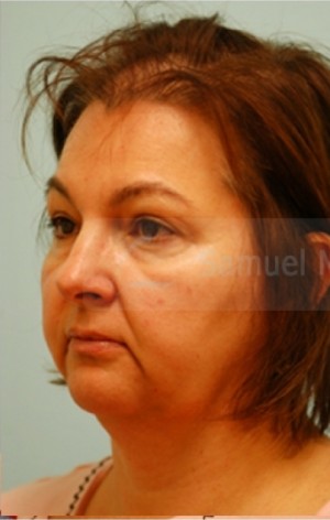 Female Hair Transplant
