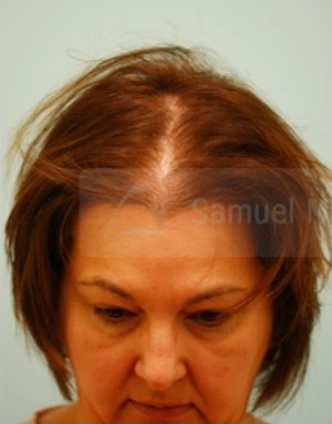 Female Hair Transplant