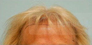 Female Hairline Lowering