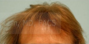 Female Hairline Lowering