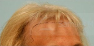 Female Hairline Lowering