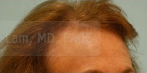 Female Hairline Lowering