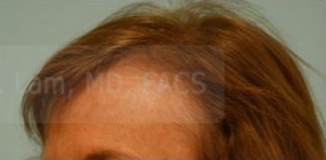 Female Hairline Lowering
