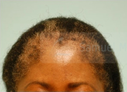 African Hair Transplant