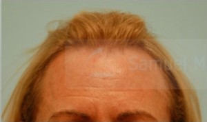 Female Hairline Lowering