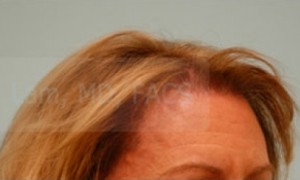 Female Hairline Lowering