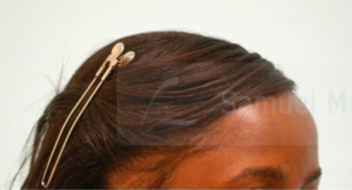 African Hair Transplant