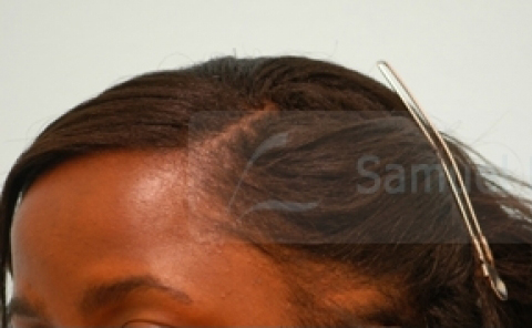 African Hair Transplant