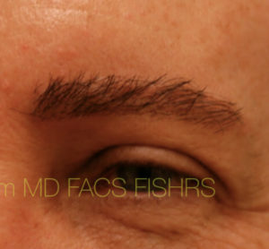 Eyebrow Hair Restoration