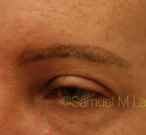 Eyebrow Hair Restoration