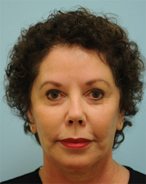 Eyebrow Hair Restoration