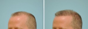 Thinning hair line and full and healthy hair, Artas Robotic Hair Transplant, Plano TX