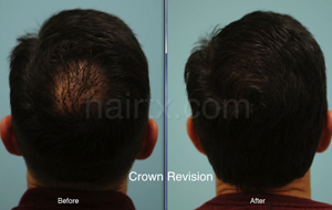 Thinning Hair crown and normal full hair, Artas Robotic Hair Transplant, Plano TX