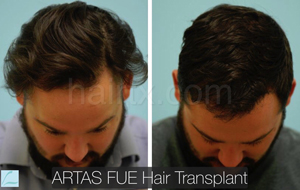 men with thinning hair and men with healthy hair top view, Artas Robotic Hair Transplant, Plano TX