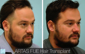 men with thinning hair and men with healthy hair left side view, Artas Robotic Hair Transplant, Plano TX