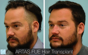 men with thinning hair and men with healthy hair right side view, Artas Robotic Hair Transplant, Plano TX