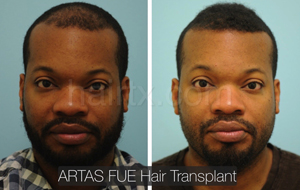 Men with thinning hair on his frontal region and men with healthy hair front view, Artas Robotic Hair Transplant, Plano TX