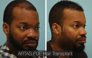 Men with thinning hair on his frontal region and men with healthy hair left side view, Artas Robotic