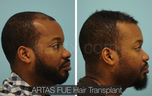 Men with thinning hair on his frontal region and men with healthy hair, Artas Robotic Hair Transplant, Plano TX