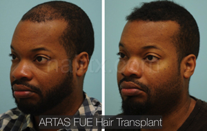 Men with thinning hair on his frontal region and men with healthy hair right side view, Artas Robotic Hair Transplant, Plano TX