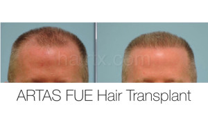 Man with receding hair line and man with healthy hair, Artas Robotic Hair Transplant, Plano TX