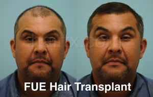 Men with thinning hair and Men after FUE Hair Transplant, Plano TX
