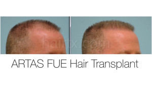 Man with receding hairline and man with healthy hair, Artas Robotic Hair Transplant, Plano TX