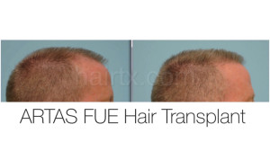 Man with thinning hairline and man with healthy hair left side view, Artas Robotic Hair Transplant, Plano TX