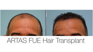 man with thinning on his frontal region and man with healthy hair, Artas Robotic Hair Transplant, Plano TX