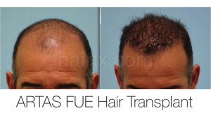 man with thinning hair on his frontal region and man with healthy hair top view, Artas Robotic Hair Transplant, Plano TX