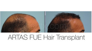 man with thinning crown and man with healthy hair, Artas Robotic Hair Transplant, Plano TX