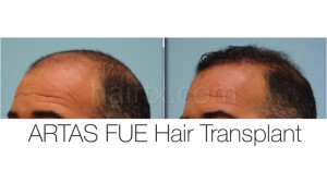 man with thinning hair on his frontal region and man with healthy hair right side view, Artas Robotic Hair Transplant, Plano TX