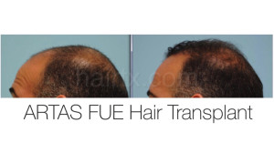 Man with thinning hair on his mid scalp and man with healthy hair right side view, Artas Robotic Hair Transplant, Plano TX