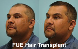 Men with thin and short hair and men with full looking longer hair, Artas Robotic Hair Transplant, Plano TX