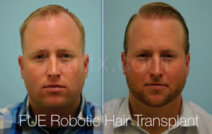 Men with receding hair line and men with healthy hair, Artas Robotic Hair Transplant, Plano TX