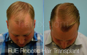 man with thinning hairline and men with healthy hair top view, Artas Robotic Hair Transplant, Plano TX