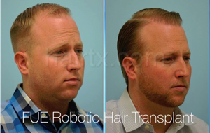Men with thinning hair line and men with healthy hair side view, Artas Robotic Hair Transplant, Plano TX