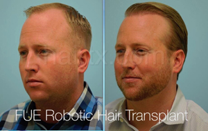 men with thinning hairline and men with healthy hair right side view, Artas Robotic Hair Transplant, Plano TX