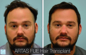 men with thinning hair and men with healthy hair front view, Artas Robotic Hair Transplant, Plano TX