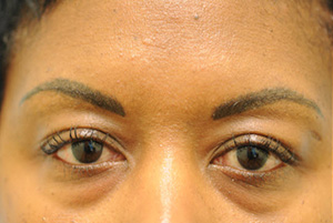 Eyebrow Hair Restoration
